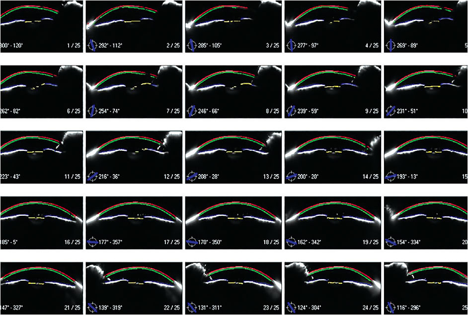 Figure 5. Tomographic corneal sections of keratoconus.