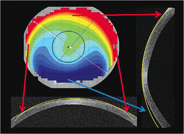 Figure 2. The elevation display map is created by the relationship of a theoretical sphere throughout the cornea.