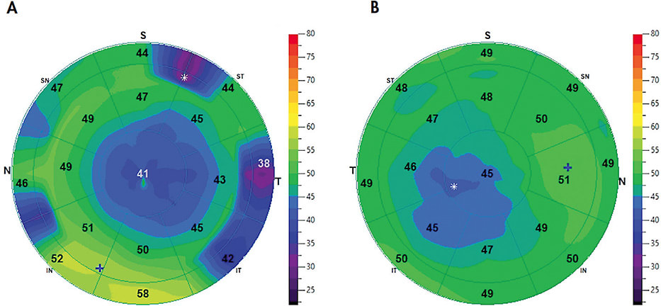 Figure 2. (A) Epithelial thickness map of a well-centered orthokeratology treatment of a patient’s left eye. (B) Epithelial thickness map of a temporally decentered orthokeratology treatment of a patient’s right eye.
