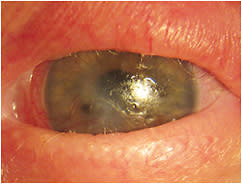 Figure 1. Left eye with OCP. She was fit with bandage soft lenses.