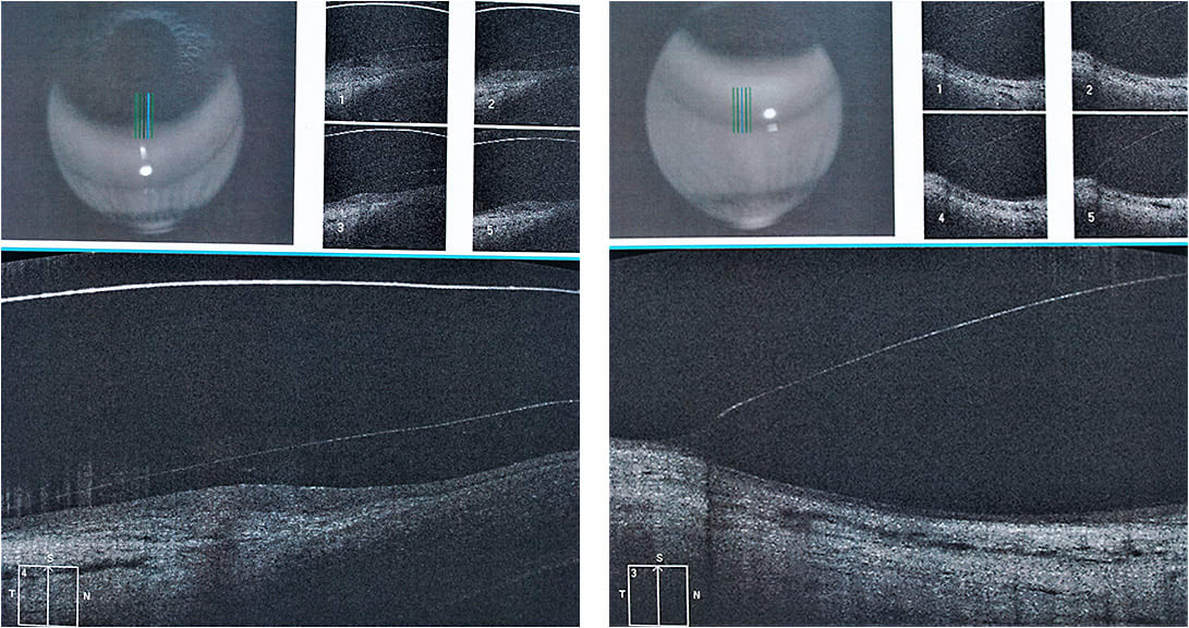 Figures 7 and 8. OCT images of the lower haptic and sclera.