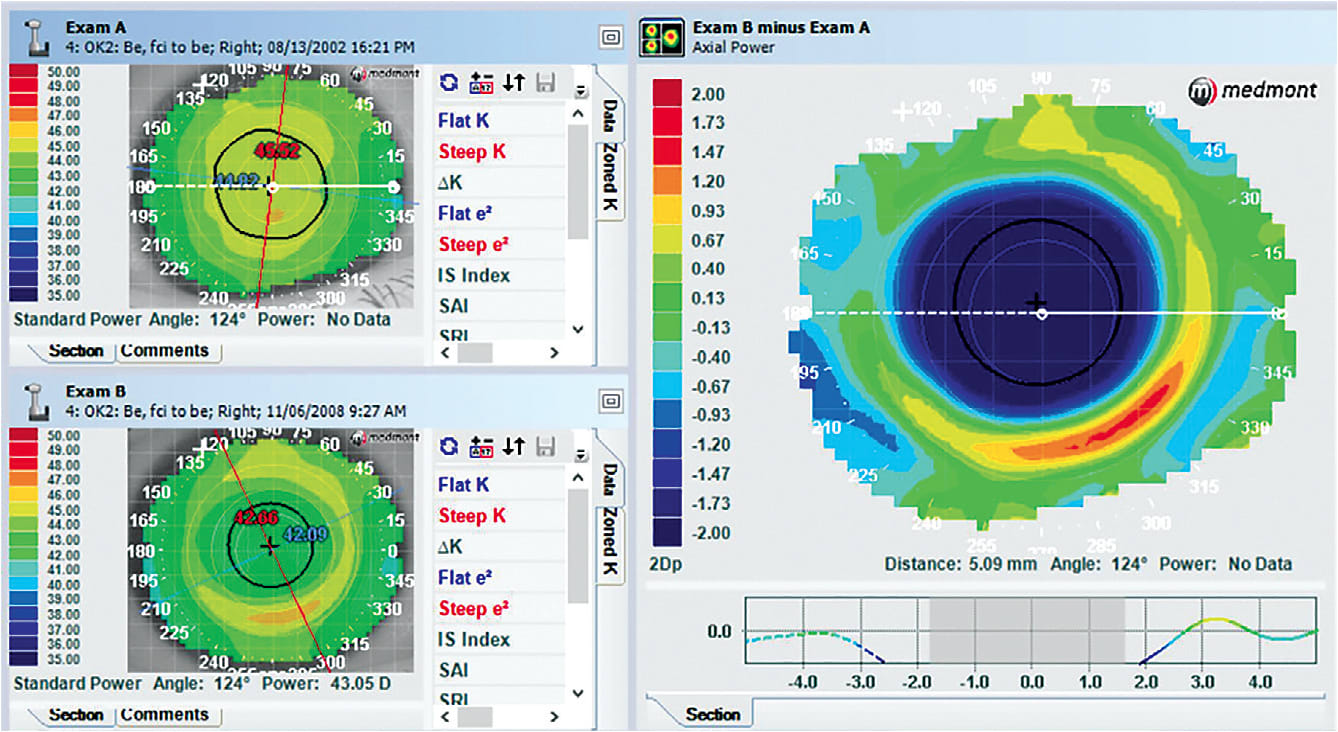 Figure 4. Subtractive map showing the effect of orthokeratology treatment. The treatment zone is well centered and homogenous.