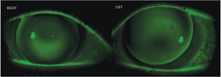 Figure 2. Fluorescein pattern of corneal GP lenses for a patient who has ectasia.