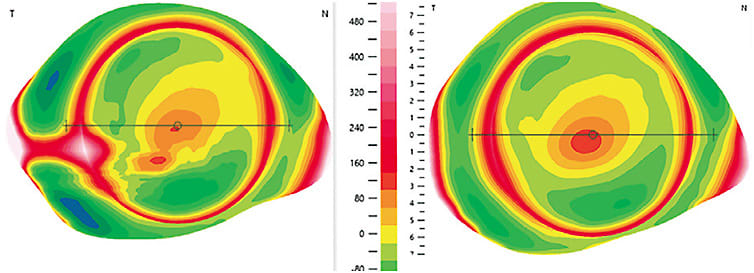 Figure 2. Profilometry of the same eye on consecutive scans. The left image has artifacts and inaccuracies. The right image is cleaner and more trustworthy. Image courtesy of Jason Jedlicka, OD