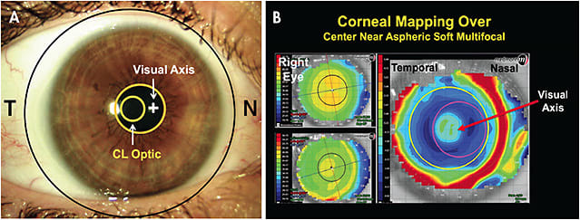 Figure 1. (A) A standard soft multifocal lens that is temporally decentered on a right eye. (B) Topography difference map showing that the optics of the lens are not centered over the patient’s visual axis.