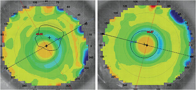 Figure 1. Multifocal decentration.Image courtesy of John Gelles, OD.