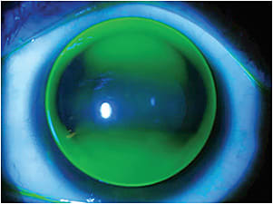 Figure 6. Spherical corneal GP contact lens on a toric cornea.