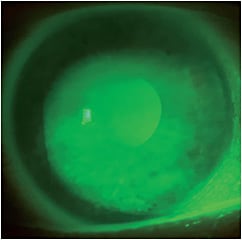 Figure 2. Resolution of punctate keratitis from NK after seven months of scleral lens wear.