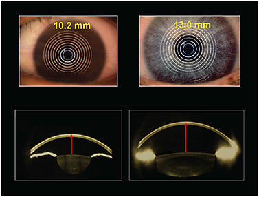 Figure 7. The impact of corneal diameter on sagittal depth of the eye. (Left) A smaller VID and subsequent shallow eye. (Right) A larger VID and subsequent deeper eye.