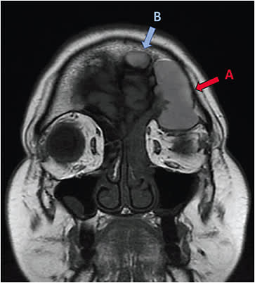 Figure 1. (A) Coronal plane MRI image of the head with a 5.3cm x 2.2cm x 2.7cm left frontoethmoidal mucocele causing secondary proptosis and hypoglobus. (B) A benign intracranial neoplasm known as a sinonasal Schneiderian inverted papilloma.