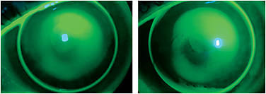 Figure 2. Corneal GP diagnostic fitting on a keratoconic eye. (Left) Three-point-touch but insufficient edge lift. (Right) Apical bearing with adequate edge lift.