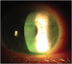 Figure 1. Punctate corneal erosions of a patient who has Sjögren’s.