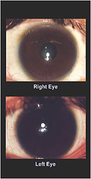 Figure 3. The soft lens fit of the right and left eyes.