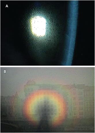 Figure 12. Our view in (A) when there is microcystic epithelial edema and the patient&#x2019;s view out (B).&#xD;&#xA;Image courtesy of Steve Byrnes, OD.