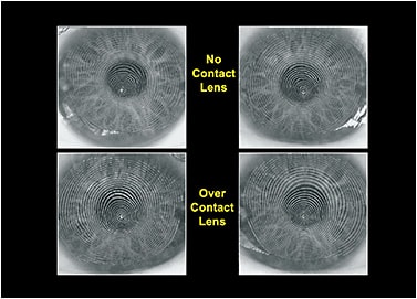 Figure 3. Evaluation of the corneal mires with no contact lens versus over a soft contact lens.