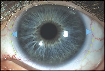 Figure 1. A concentric multifocal lens with center-near optics settled on patient eye, OS. The blue triangles are of equal size to highlight lens centration.