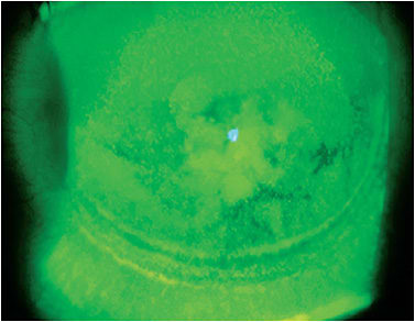 Figure 11. Scleral lens-induced mechanical damage to the epithelium resulting when settling was not accounted for and a lens with a shallow central clearance was dispensed.