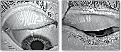 Figure 1. Incipient dropout (left) and severe dropout (right) in meibomian gland dysfunction. Courtesy of William Townsend, OD