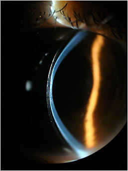 Figure 4. Same OS scleral lens as shown in Figure 3 from 2020, now nearly touching the corneal apex in January 2022.