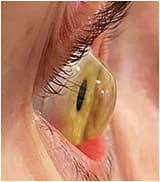 Figure 4. Impression-molded lens on eye.