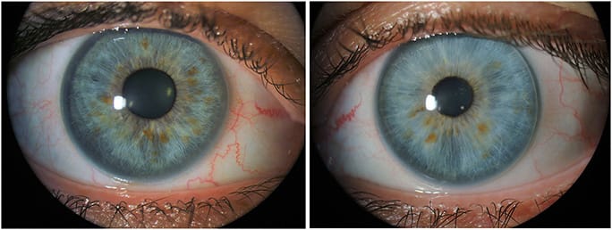 Figure 5. The intralimbal GPs on eye prior to fluorescein instillation.