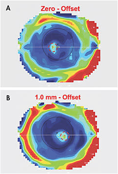 Figure 2. (A) A topography map with a near-center multifocal lens on eye OD. The red dashed circle shows the approximate area of the temporally decentered near optics. (B) With offset optics, the red dashed circle outlining the near center is now positioned nasally.