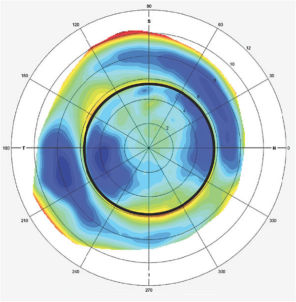 Figure 1. Corneoscleral elevation map showing paralimbal elevation changes of the cornea that continue onto the scleral surface. The limbus is defined by the black circle.