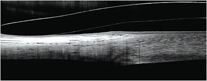 Figure 5. An evident reverse curve ensures appropriate clearance over the central cornea post-refractive surgery.