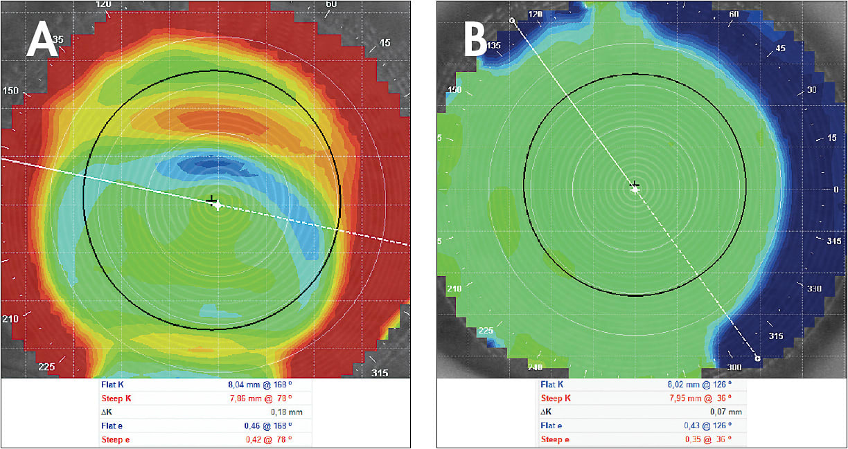 Figure 1. Topography over scleral lenses to detect the presence of lens flexure/torsion. (A) Topography showing lens torsion. (B) Topography over toric landing zone managing lens torsion.