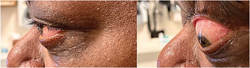 Figure 2. (Left) The patient’s left eye in profile without lid manipulation. (Right) Proptosis with upper lid manipulation.