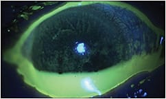 Figure 1. Our patient had poor eyelid apposition, with fluorescein pooling in the unopposed inferior lid.