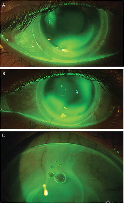 Figure 4. Entry of fluorescein into the liquid reservoir after applying a spherical SL. (A) Little influx due to little scleral toricity. (B) Greater influx in higher scleral toricity. (C) Excessive entry of fluorescein due to very high scleral toricity, also allowing air bubbles to enter behind the SL. 
Figure 3C courtesy of Karen Carrasquillo, OD