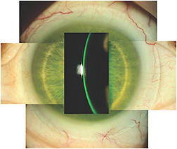Figure 19. Scleral lens on Case 4 patient’s left eye. This lens was the initial lens designed entirely from scleral topography. The central clearance was measured at 300 microns 30 minutes after application, and the scleral zone showed proper alignment 360º around.