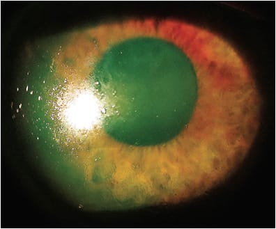 Figure 2. A patient experiencing lens wettability issues.