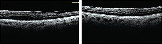 Figure 1. Retinal disease such as macular pucker may cause aniseikonia.Image courtesy of Claudia Hnulik, BS