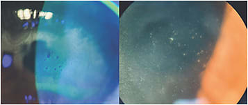 Figure 1. (Left) Positive and negative staining over central corneal opacities. (Right) Diffuse bread-crumb-like granular intra-epithelial lesions (25x magnification).