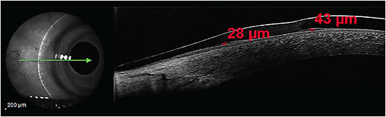 Figure 3. Areas of clearance before and after the junction of a hybrid lens (8.1mm skirt curve).