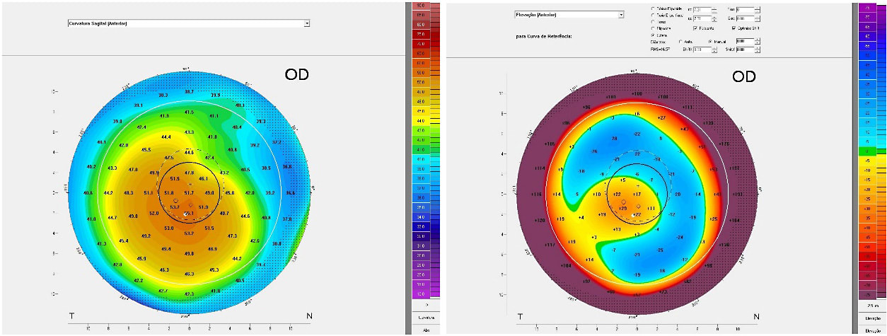 Figures 2 and 3. Anterior sagittal curve and anterior elevation maps.