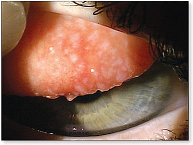 Figure 2. Giant papillary conjunctivitis.