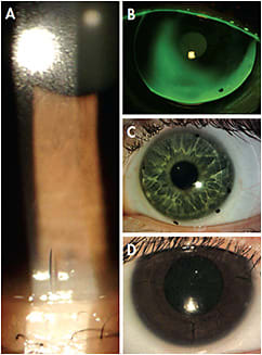 Figure 1. Examples of CL toric markings: A) soft contact lens, B) GP lens, C) scleral lens, and D) soft contact lens.