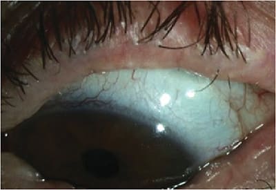 FIGURE 5. Trichiasis and distichiasis in a patient with SJS. Photo courtesy of Gloria Chiu, OD.