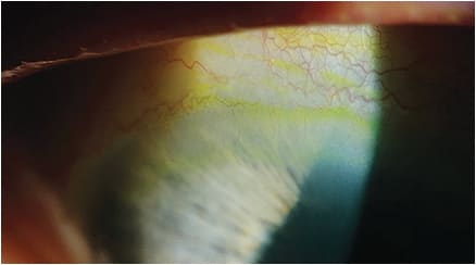 Figure 8. Vascularization along the superior limbus. The lens material has a Dk of 141, a lens thickness over the limbus of 0.35mm, and a tear lens thickness of 30 microns.&#xD;&#xA;Image courtesy of Steve Byrnes, OD.