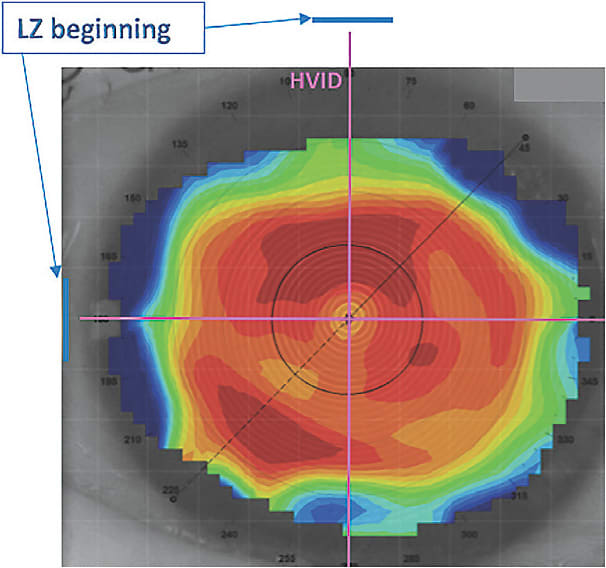 Figure 3. Illustration showing the starting point of the landing zone of a scleral lens that has a design that is based on the HVID value.