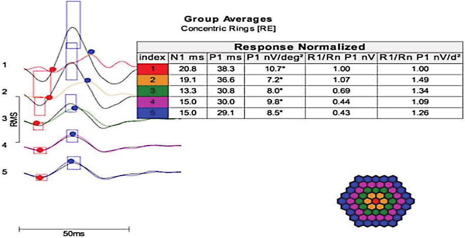 Figure 2. The tables show average responses from the fovea and each surrounding color-coded ring. The right ratio is not elevated because of the advanced stage of retinal damage in the fovea, diminishing the foveal mfERG amplitude compared to the second ring. The mfERG shows significant reduction in the amplitude in first two rings OD.