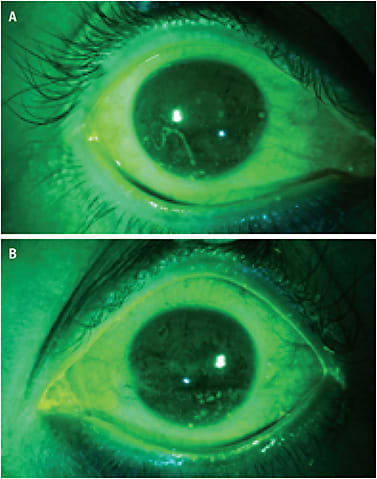 FIGURE 1. Ocular surface of the eye of a patient who has Sjögren’s. Diminished tear film, corneal staining, mucus strands, and filaments can be appreciated through a Wratten filter with cobalt blue light.Photos courtesy of Gloria Chiu, OD.