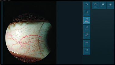 Figure 3. The use of software to enhance lens fitting. In this picture, the vessel enhancement option has been used to better assess vessel compression where the scleral lens is bearing on the sclera. Image Courtesy of Advanced Ophthalmic Systems