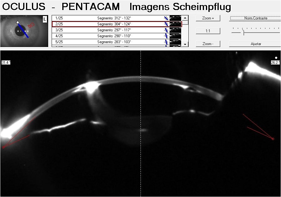 Figure 3. OS Scheimpflug image showing the inferior elevation of the temporal ring.