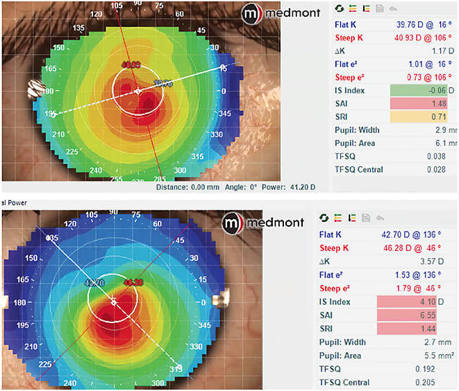 Figure 2. Baseline topography of a patient fit into a custom soft lens for keratoconus. Note the high astigmatism (OS bottom &gt; OD top) but relatively mild form of the disease due to corneal cross-linking.