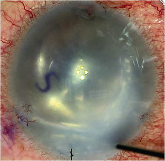 FIGURE 1: Note the “S” stamp showing proper graft orientation after SF6 gas instillation. IMAGE COURTESY NANDINI VENKATESWARAN, MD