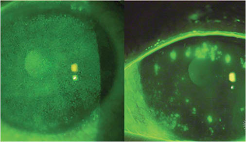 FIGURE 1: Bandage soft lenses can also offer relief to cGVHD patients.IMAGES COURTESY OF GREG DENAEYER, OD, AND DEBORAH JACOBS, MD, MS